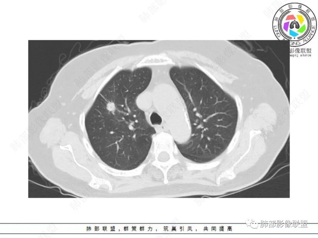 影像PPT - 【病例】孤立结节辨良恶,寻找细节定乾坤!-6 影像PPT - 【病例】孤立结节辨良恶,寻找细节定乾坤!-6