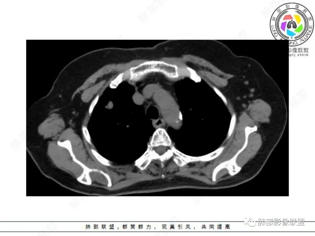 影像PPT - 【病例】孤立结节辨良恶,寻找细节定乾坤!-7 影像PPT - 【病例】孤立结节辨良恶,寻找细节定乾坤!-7