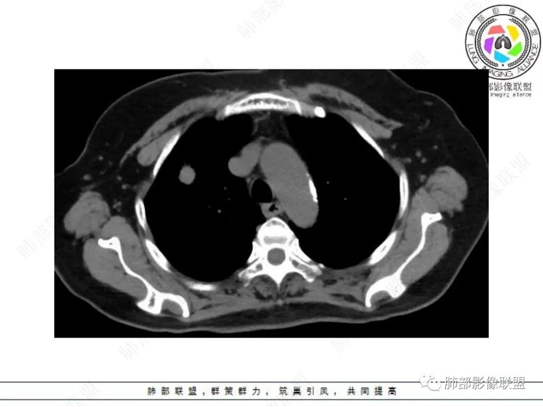 影像PPT - 【病例】孤立结节辨良恶,寻找细节定乾坤!-9 影像PPT - 【病例】孤立结节辨良恶,寻找细节定乾坤!-9