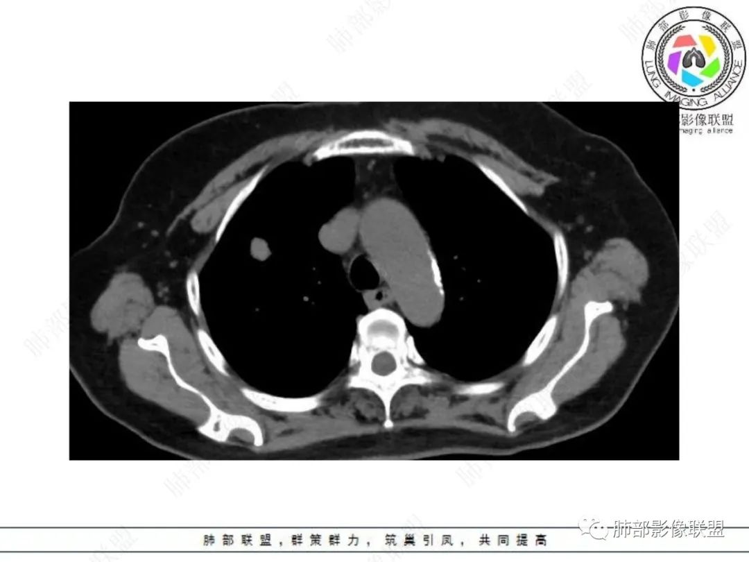 影像PPT - 【病例】孤立结节辨良恶,寻找细节定乾坤!-10 影像PPT - 【病例】孤立结节辨良恶,寻找细节定乾坤!-10
