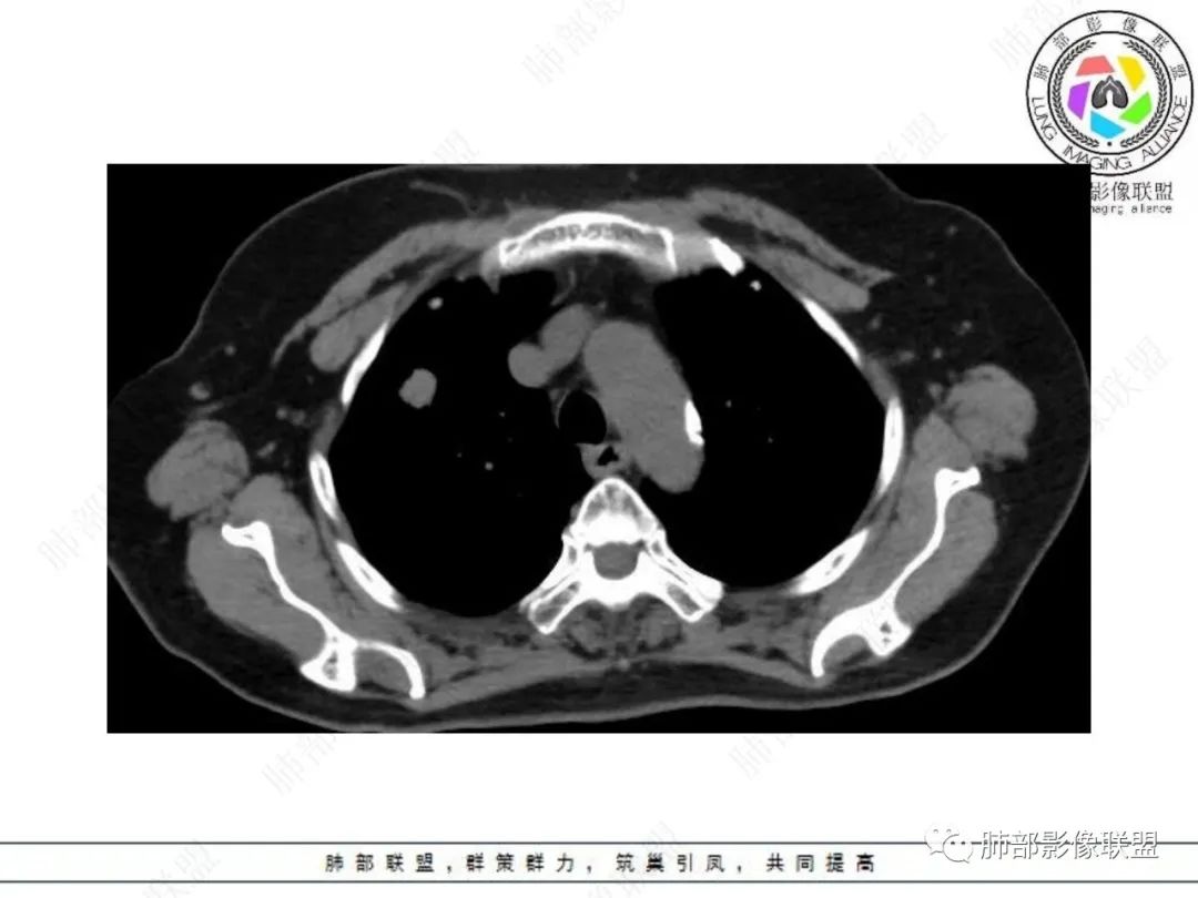 影像PPT - 【病例】孤立结节辨良恶,寻找细节定乾坤!-8 影像PPT - 【病例】孤立结节辨良恶,寻找细节定乾坤!-8