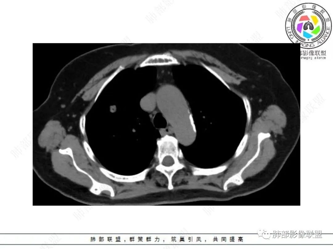 影像PPT - 【病例】孤立结节辨良恶,寻找细节定乾坤!-11 影像PPT - 【病例】孤立结节辨良恶,寻找细节定乾坤!-11