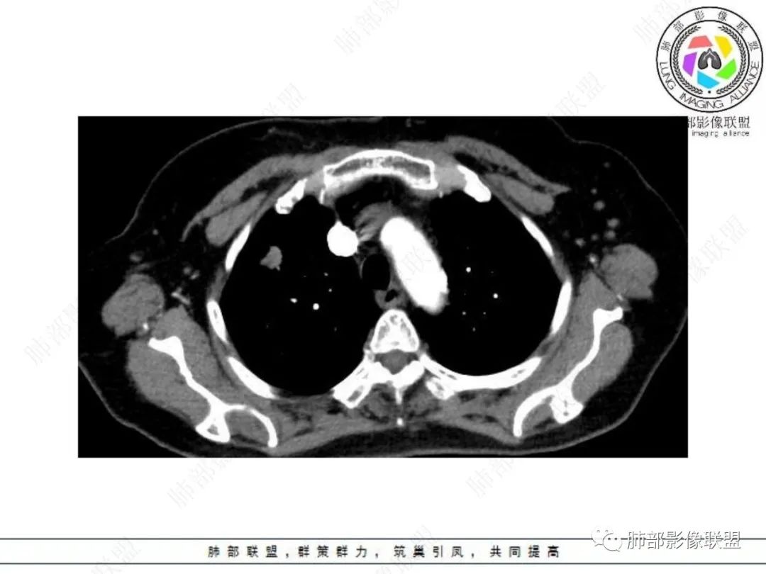 影像PPT - 【病例】孤立结节辨良恶,寻找细节定乾坤!-12 影像PPT - 【病例】孤立结节辨良恶,寻找细节定乾坤!-12