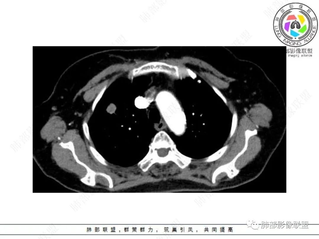 影像PPT - 【病例】孤立结节辨良恶,寻找细节定乾坤!-13 影像PPT - 【病例】孤立结节辨良恶,寻找细节定乾坤!-13