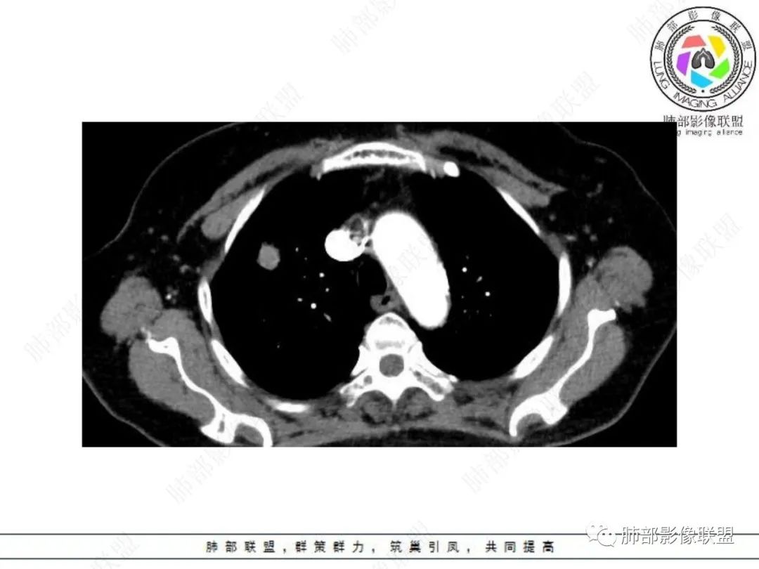 影像PPT - 【病例】孤立结节辨良恶,寻找细节定乾坤!-14 影像PPT - 【病例】孤立结节辨良恶,寻找细节定乾坤!-14