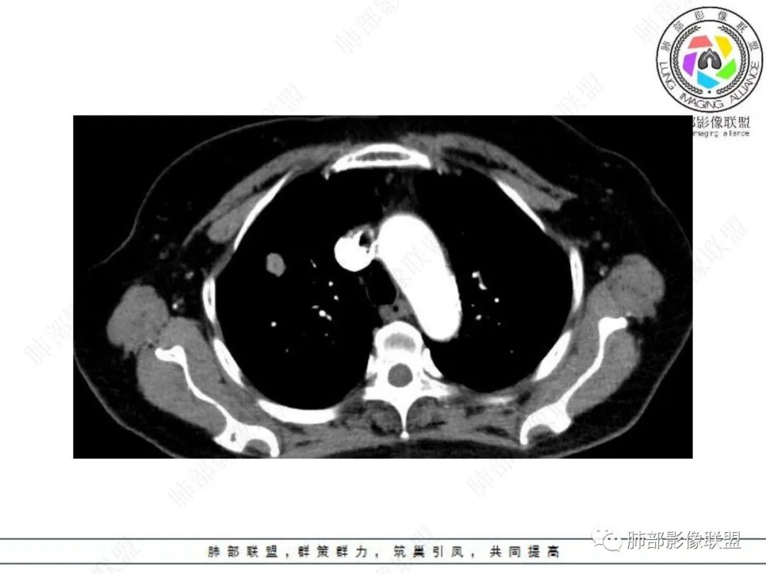 影像PPT - 【病例】孤立结节辨良恶,寻找细节定乾坤!-15 影像PPT - 【病例】孤立结节辨良恶,寻找细节定乾坤!-15