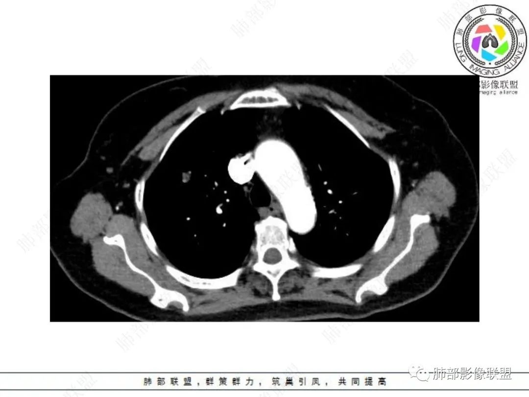 影像PPT - 【病例】孤立结节辨良恶,寻找细节定乾坤!-16 影像PPT - 【病例】孤立结节辨良恶,寻找细节定乾坤!-16
