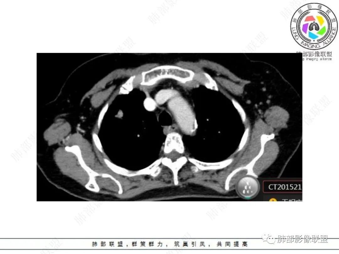 影像PPT - 【病例】孤立结节辨良恶,寻找细节定乾坤!-17 影像PPT - 【病例】孤立结节辨良恶,寻找细节定乾坤!-17