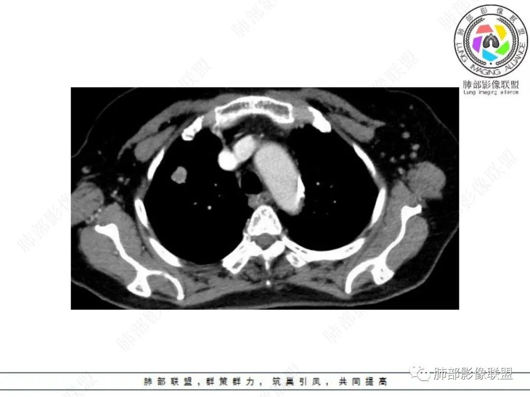 影像PPT - 【病例】孤立结节辨良恶,寻找细节定乾坤!-18 影像PPT - 【病例】孤立结节辨良恶,寻找细节定乾坤!-18