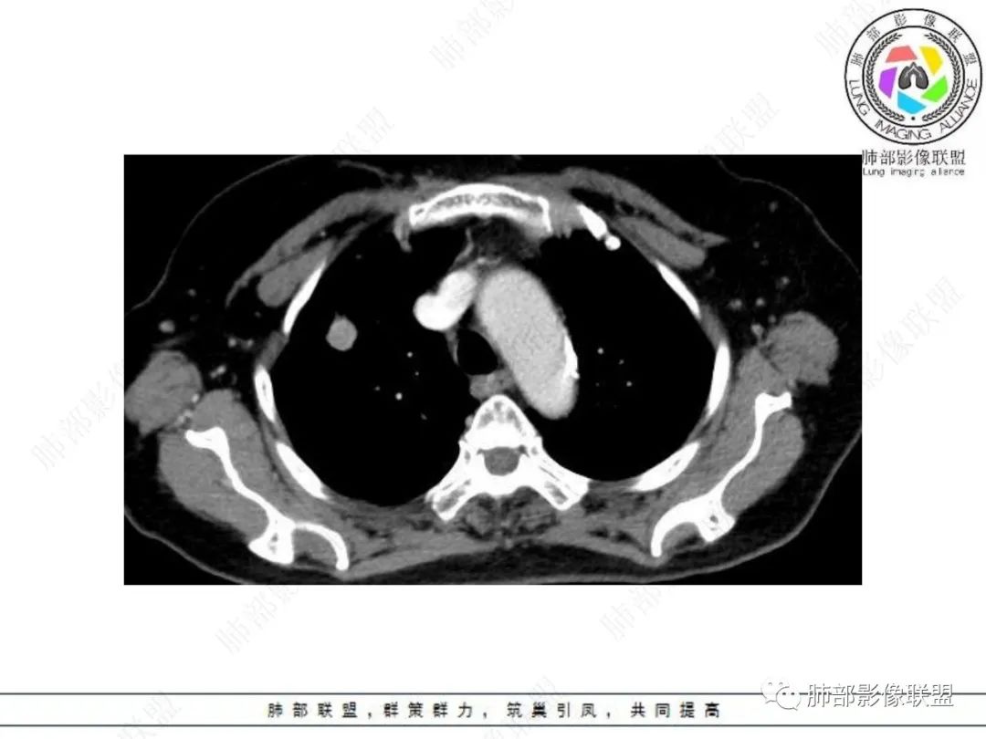 影像PPT - 【病例】孤立结节辨良恶,寻找细节定乾坤!-19 影像PPT - 【病例】孤立结节辨良恶,寻找细节定乾坤!-19