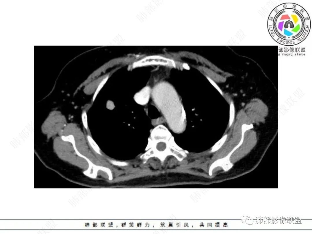 影像PPT - 【病例】孤立结节辨良恶,寻找细节定乾坤!-20 影像PPT - 【病例】孤立结节辨良恶,寻找细节定乾坤!-20