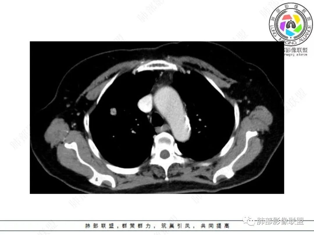 影像PPT - 【病例】孤立结节辨良恶,寻找细节定乾坤!-21 影像PPT - 【病例】孤立结节辨良恶,寻找细节定乾坤!-21