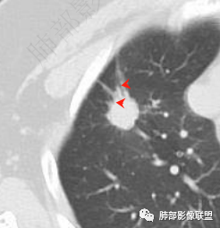 影像PPT - 【病例】孤立结节辨良恶,寻找细节定乾坤!-31 影像PPT - 【病例】孤立结节辨良恶,寻找细节定乾坤!-31