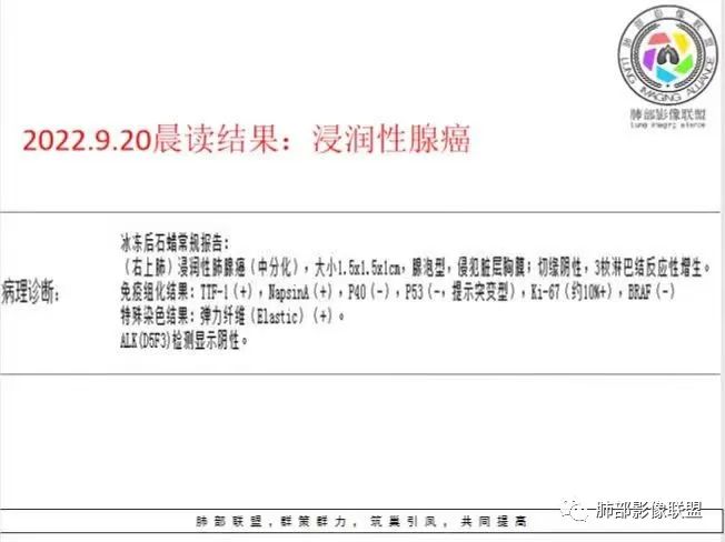 影像PPT - 【病例】孤立结节辨良恶,寻找细节定乾坤!-33 影像PPT - 【病例】孤立结节辨良恶,寻找细节定乾坤!-33