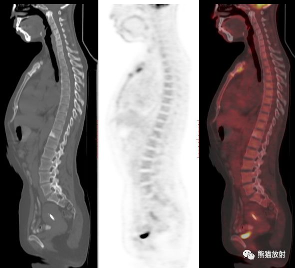 影像PPT - SAPHO综合征影像学表现-6 影像PPT - SAPHO综合征影像学表现-6