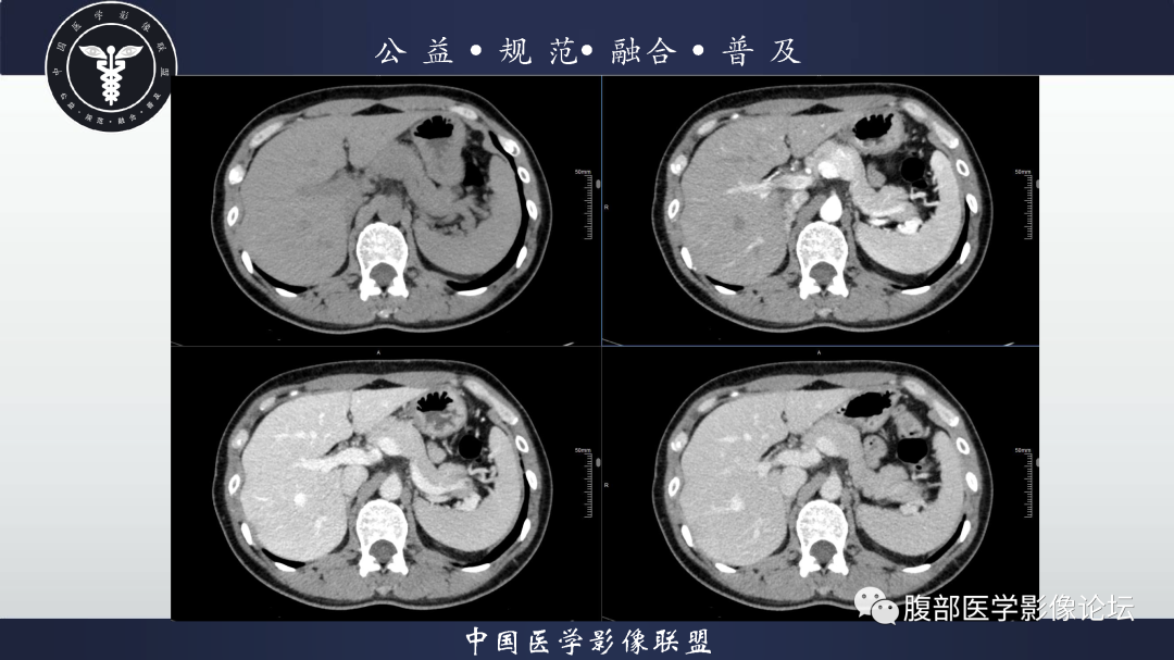 影像PPT - 【病例】腹膜后边缘区淋巴瘤1例CT影像-4