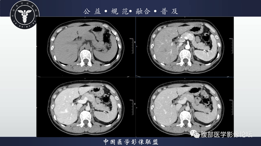 影像PPT - 【病例】腹膜后边缘区淋巴瘤1例CT影像-5