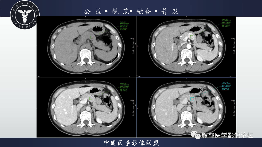 影像PPT - 【病例】腹膜后边缘区淋巴瘤1例CT影像-6
