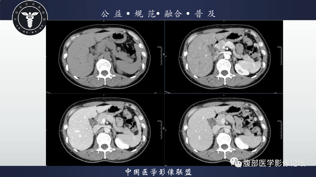 影像PPT - 【病例】腹膜后边缘区淋巴瘤1例CT影像-7