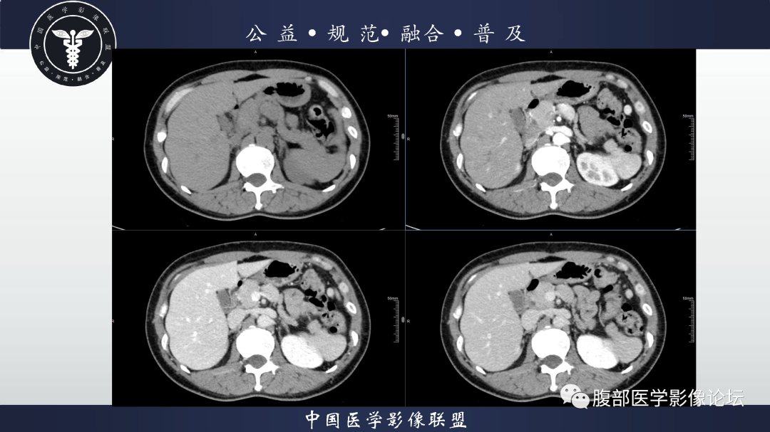 影像PPT - 【病例】腹膜后边缘区淋巴瘤1例CT影像-8