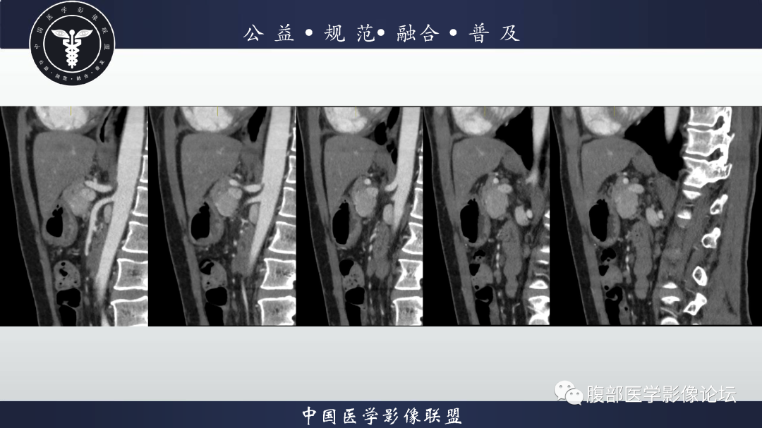 影像PPT - 【病例】腹膜后边缘区淋巴瘤1例CT影像-9