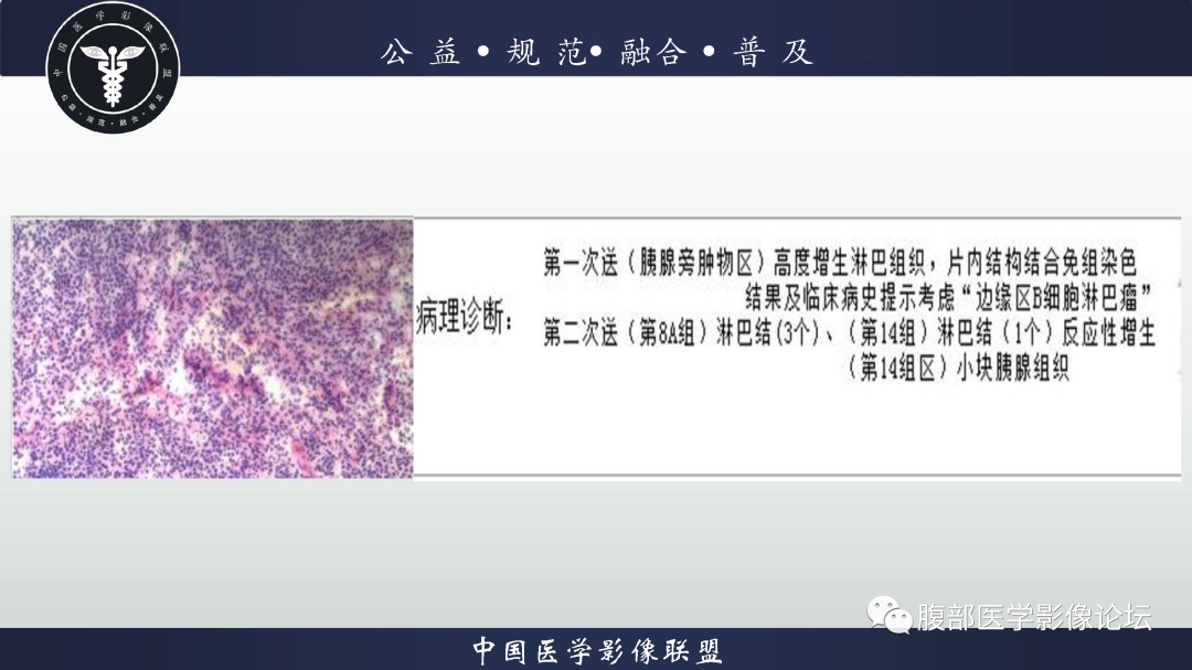 影像PPT - 【病例】腹膜后边缘区淋巴瘤1例CT影像-10