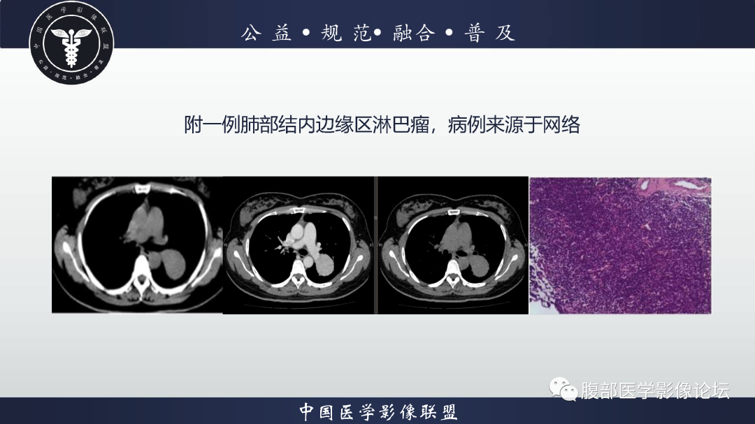 影像PPT - 【病例】腹膜后边缘区淋巴瘤1例CT影像-13