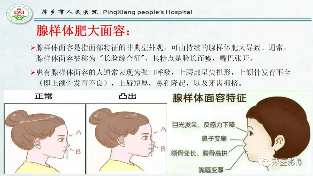 影像PPT - 【PPT】腺样体肥大的影像表现及诊断标准-7