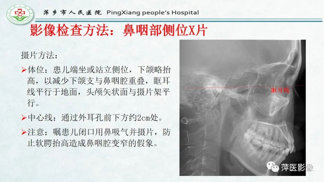 影像PPT - 【PPT】腺样体肥大的影像表现及诊断标准-9