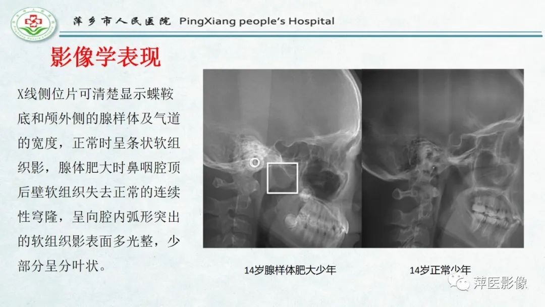 影像PPT - 【PPT】腺样体肥大的影像表现及诊断标准-11