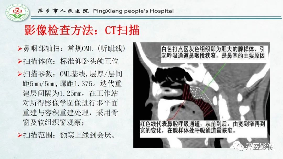 影像PPT - 【PPT】腺样体肥大的影像表现及诊断标准-10