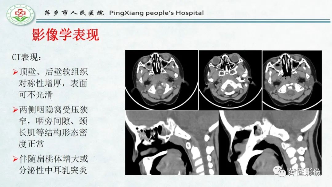 影像PPT - 【PPT】腺样体肥大的影像表现及诊断标准-12