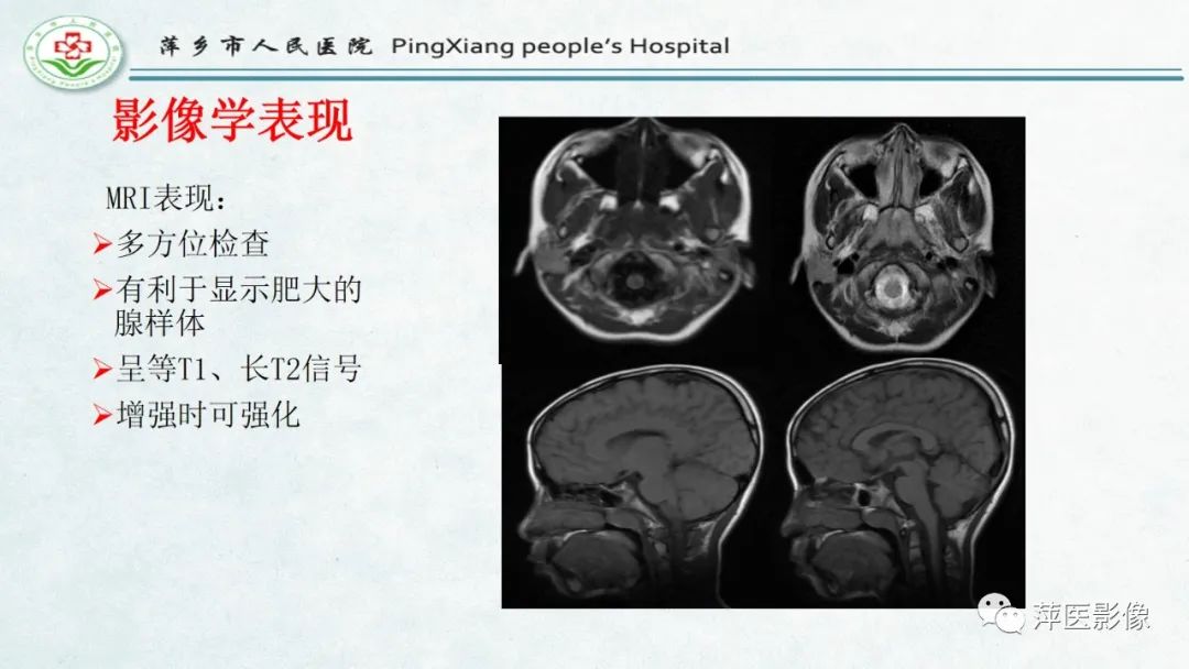 影像PPT - 【PPT】腺样体肥大的影像表现及诊断标准-13