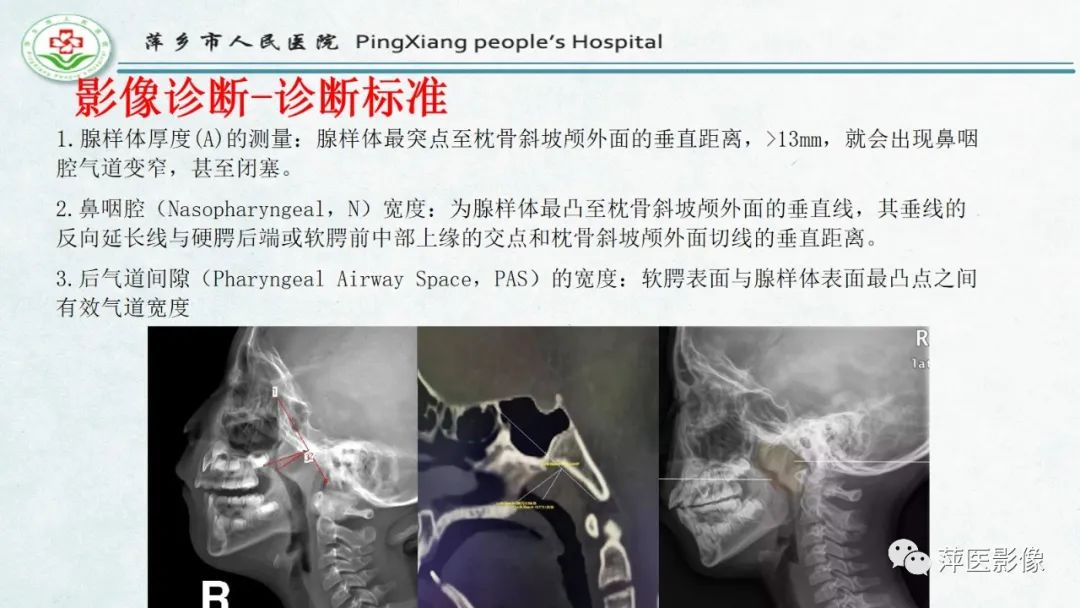 影像PPT - 【PPT】腺样体肥大的影像表现及诊断标准-14