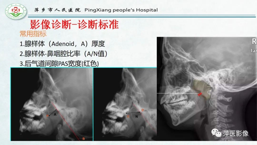 影像PPT - 【PPT】腺样体肥大的影像表现及诊断标准-15