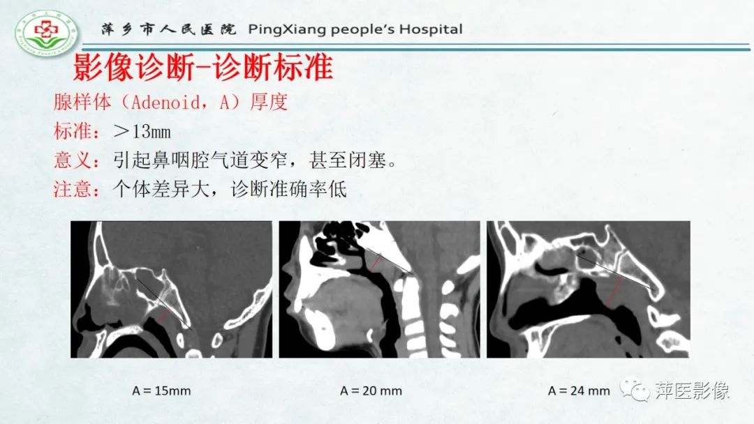 影像PPT - 【PPT】腺样体肥大的影像表现及诊断标准-16