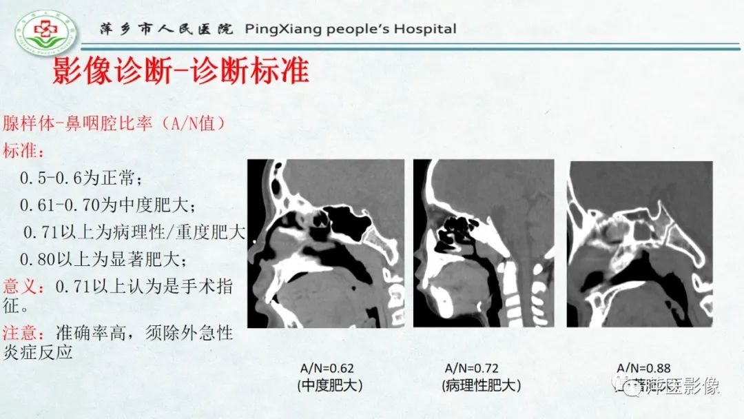 影像PPT - 【PPT】腺样体肥大的影像表现及诊断标准-17
