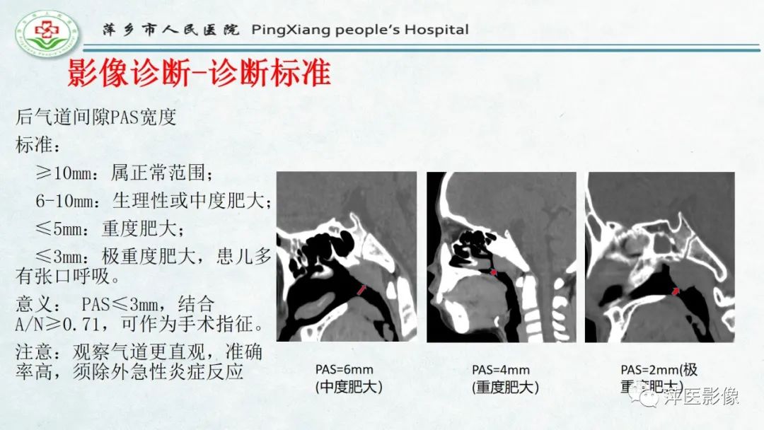 影像PPT - 【PPT】腺样体肥大的影像表现及诊断标准-18