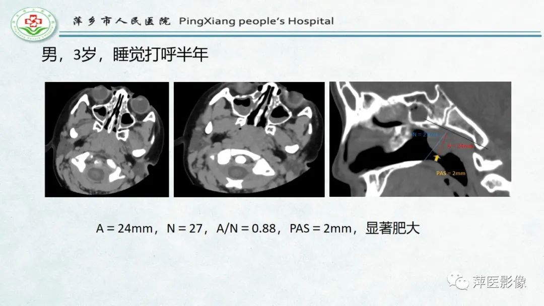 影像PPT - 【PPT】腺样体肥大的影像表现及诊断标准-20