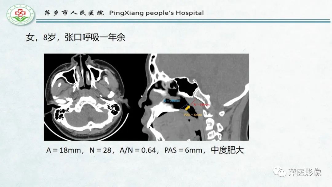 影像PPT - 【PPT】腺样体肥大的影像表现及诊断标准-21