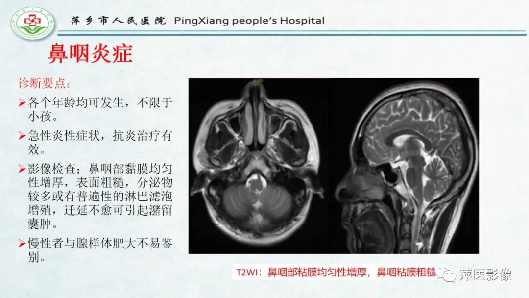 影像PPT - 【PPT】腺样体肥大的影像表现及诊断标准-22