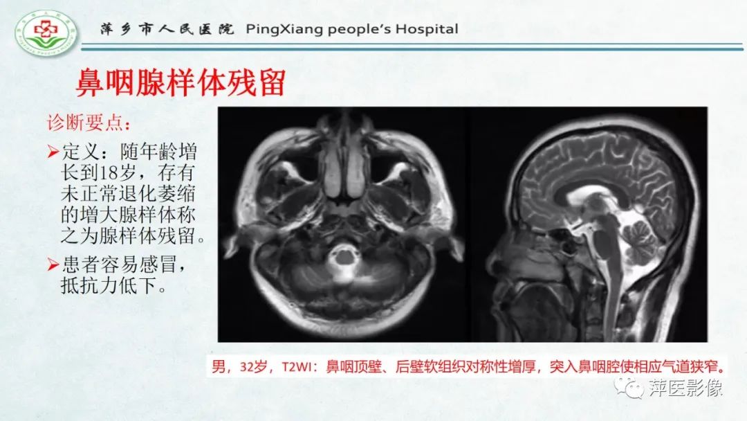 影像PPT - 【PPT】腺样体肥大的影像表现及诊断标准-23