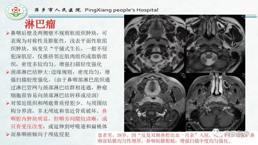 影像PPT - 【PPT】腺样体肥大的影像表现及诊断标准-24