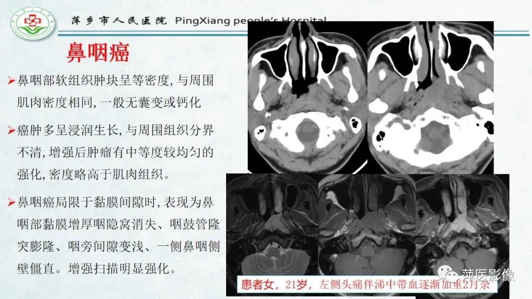 影像PPT - 【PPT】腺样体肥大的影像表现及诊断标准-25