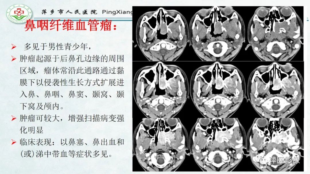 影像PPT - 【PPT】腺样体肥大的影像表现及诊断标准-26