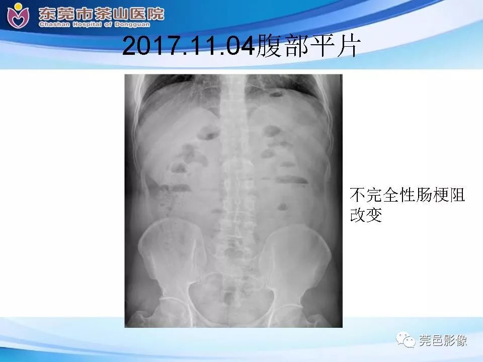 影像PPT - 【PPT】腹茧症的影像诊断-6