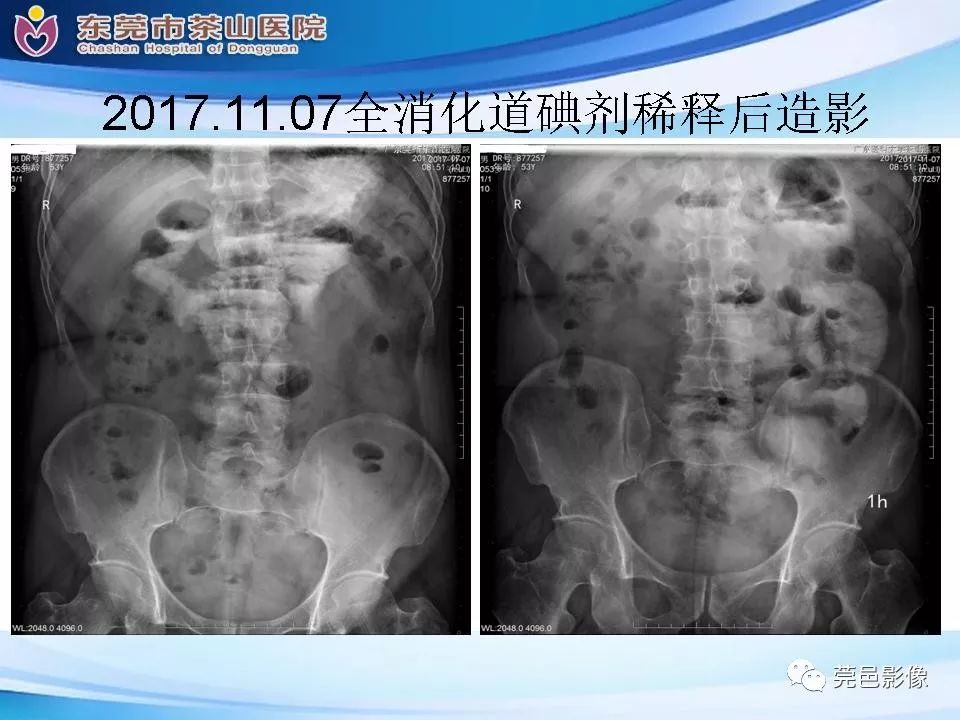 影像PPT - 【PPT】腹茧症的影像诊断-7