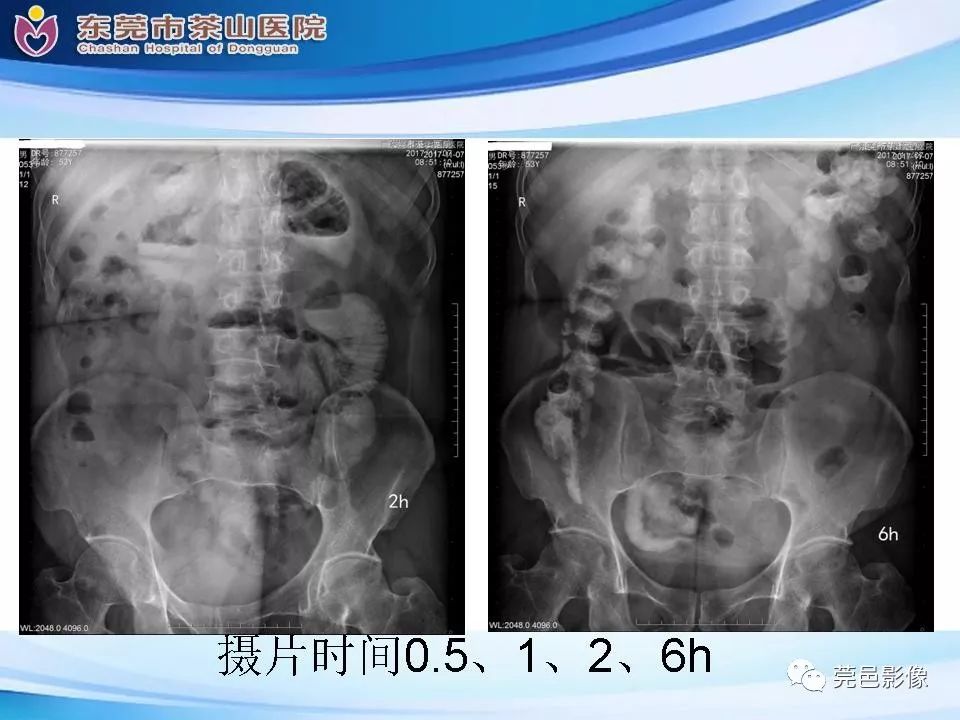 影像PPT - 【PPT】腹茧症的影像诊断-8
