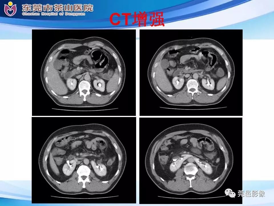 影像PPT - 【PPT】腹茧症的影像诊断-14