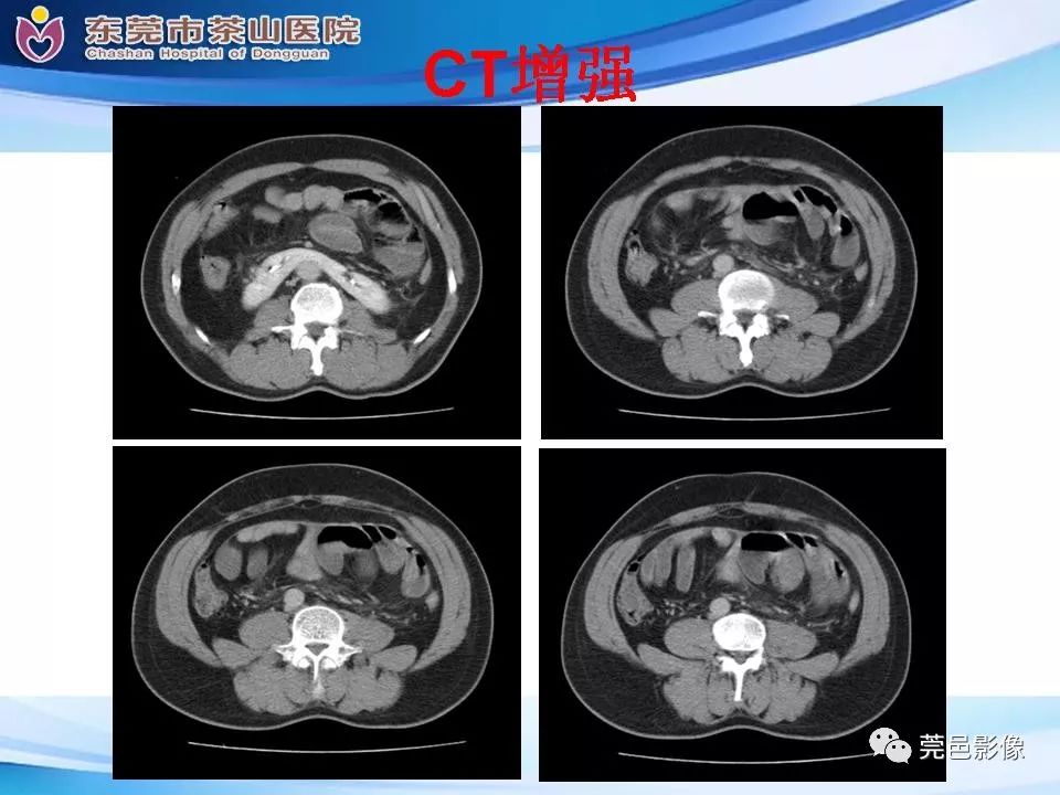 影像PPT - 【PPT】腹茧症的影像诊断-15